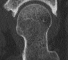 Hip Cam CT Sagittal